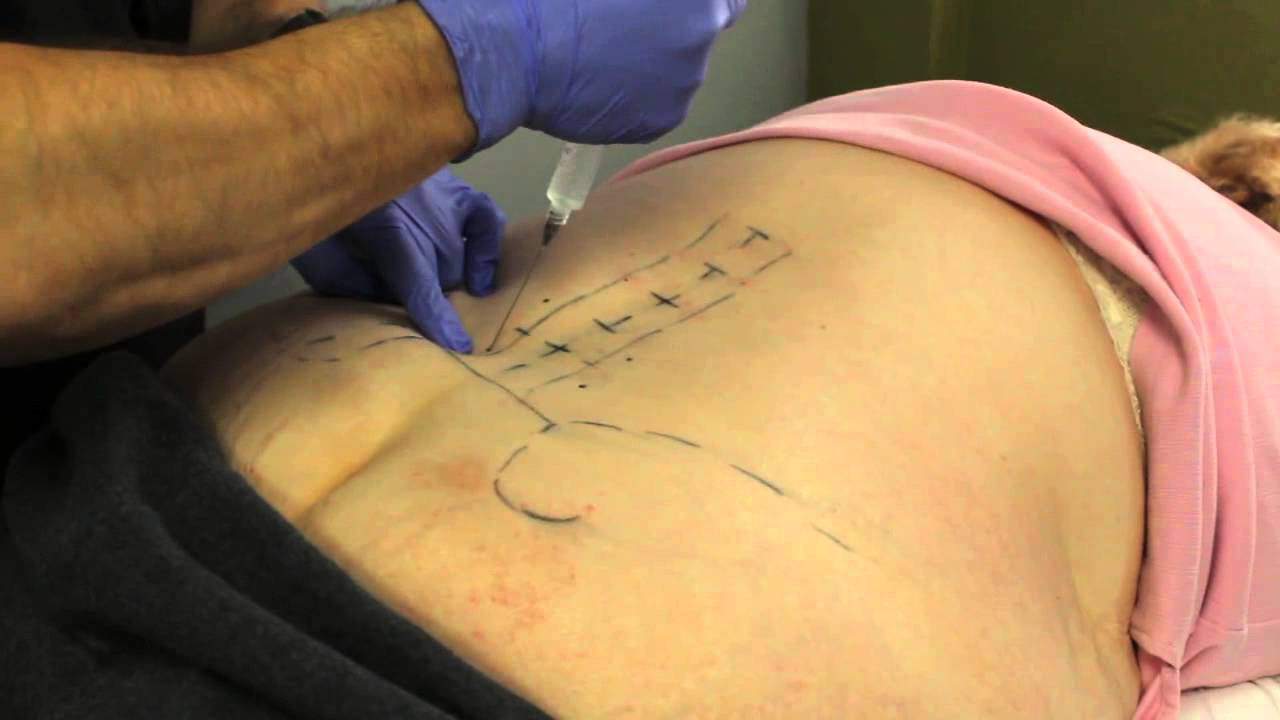 Proloterapi SGK Karşılıyor Mu