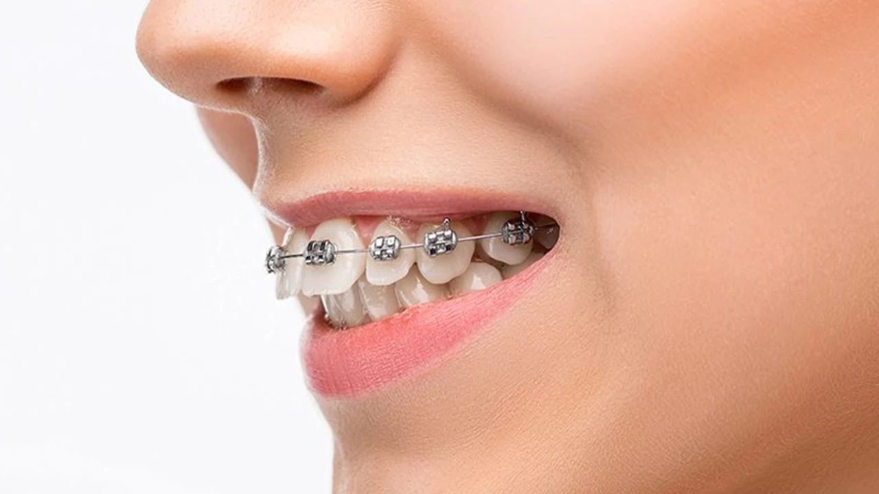 Yeşil Kart Diş Telini Karşılıyor Mu